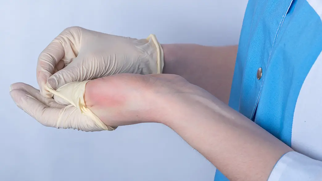 A young woman removing latex gloves, revealing red skin underneath, possibly due to a latex allergy